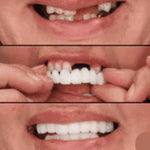 CARILLAS DENTALES
